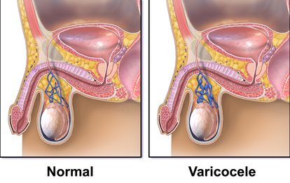 What is the Varicocelectomy procedure? || image