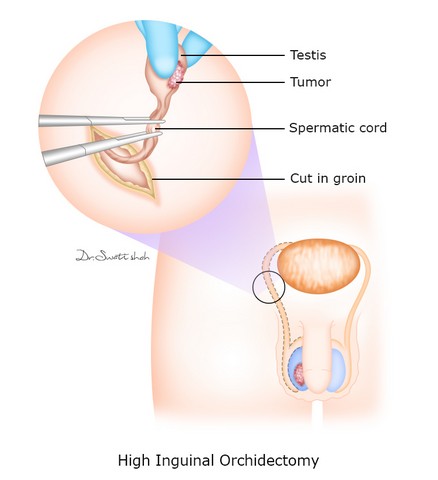 What is Orchidectomy? || image