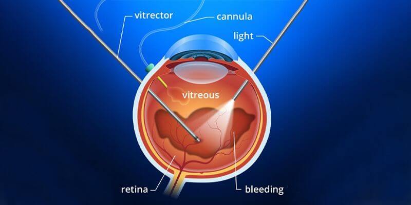 Vitrectomy Surgery Benefits Risks Recovery Vitrectomy Surgery Benefits Risks Recovery