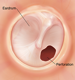 Perforated Eardrum Symptoms Causes Treatment Antibiotics