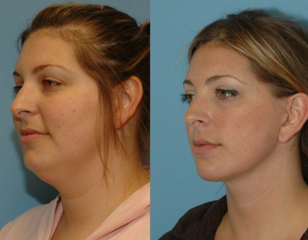 What is Neck Lift? || image