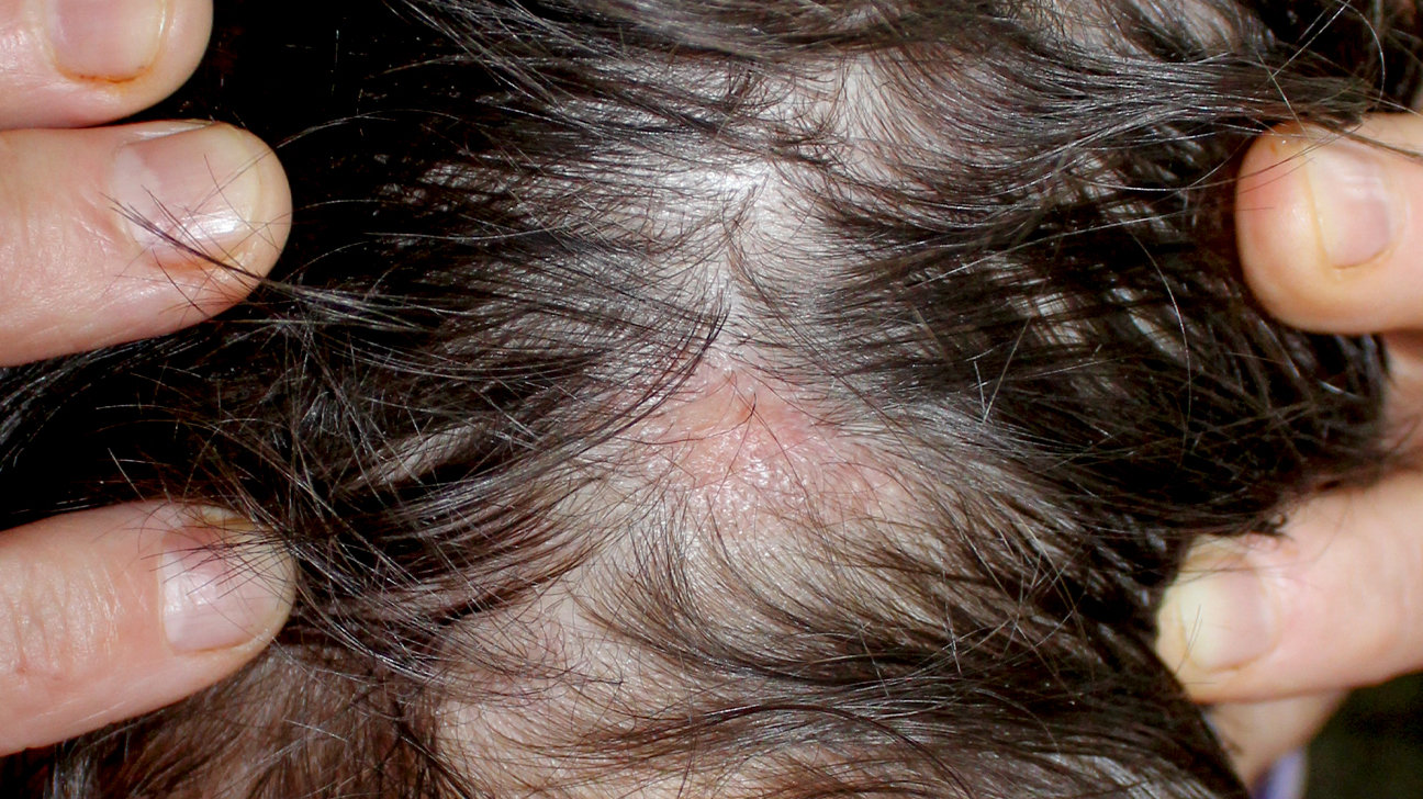 Types of Disease That Cause Hair Loss Manhattan, NYC - The Hair