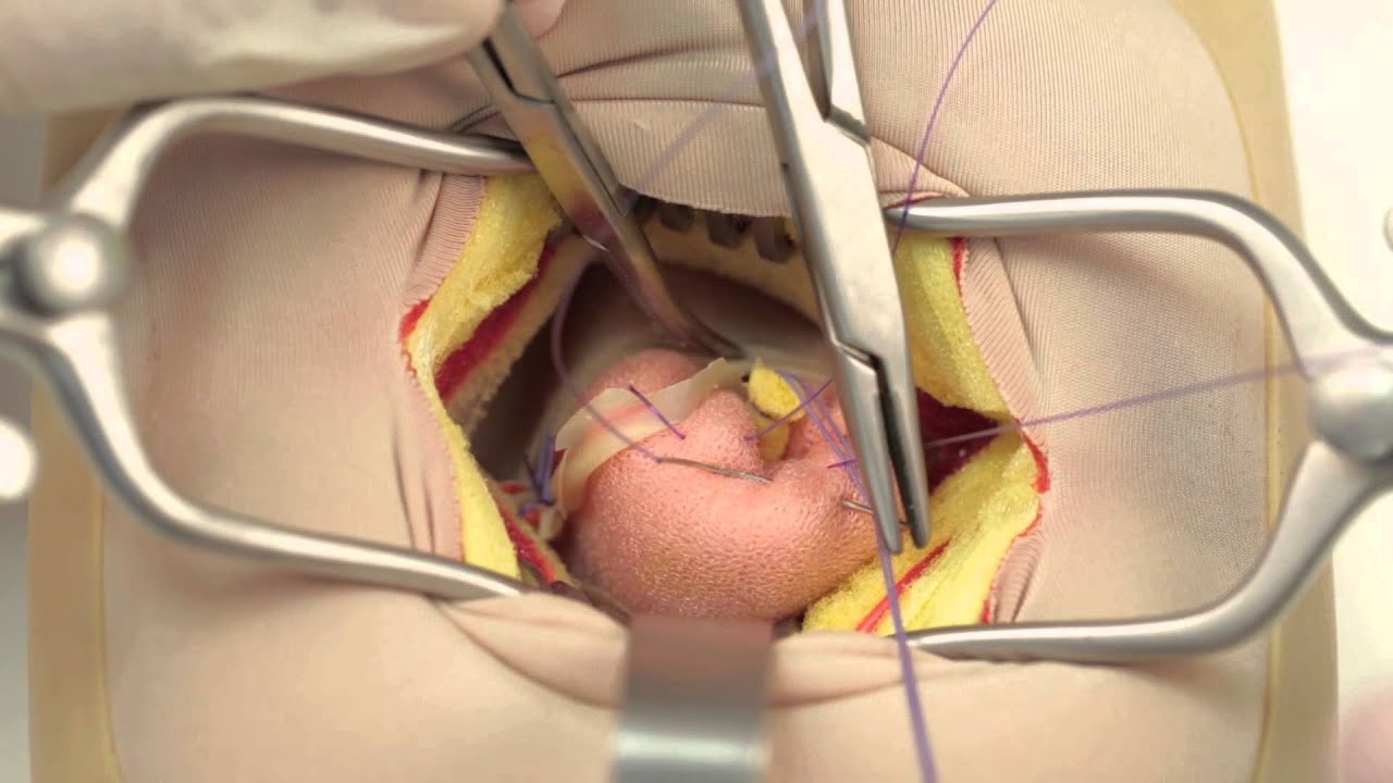 Open Appendectomy || image