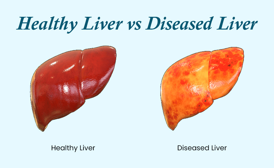 Healthy vs Fatty Liver