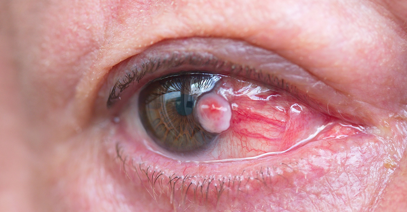 What is Pterygium Excision? || image