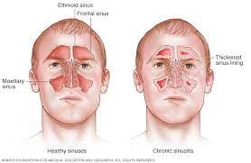 Sinusitis || image