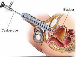 Cystoscopy Procedure || image