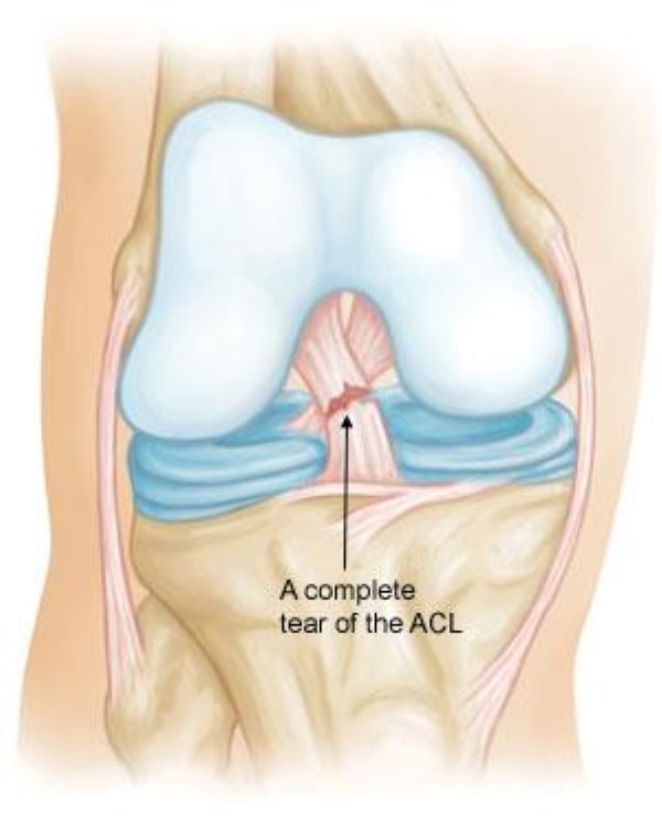 What is ACL Tear? || image