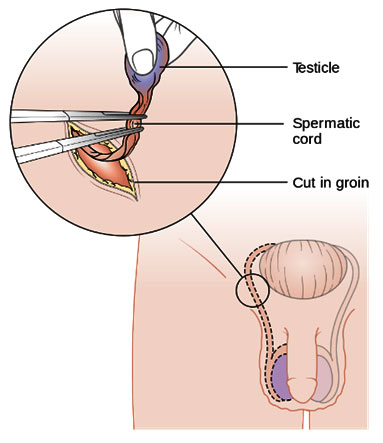 How is Male to Female Surgery Performed? || image