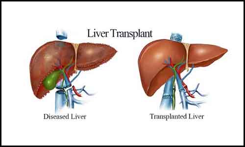 How is Acute Liver Failure diagnosed? || image