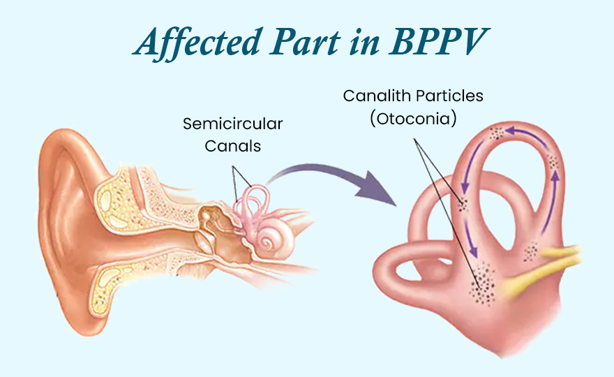 Benign Paroxysmal Positional Vertigo Symptoms And Treatment Benign Paroxysmal Positional Vertigo Symptoms And Treatment