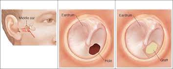 Eardrum Perforation Treatment || image